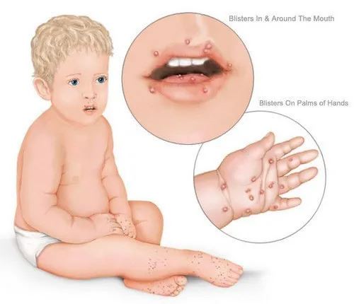 Hand Foot and Mouth Disease